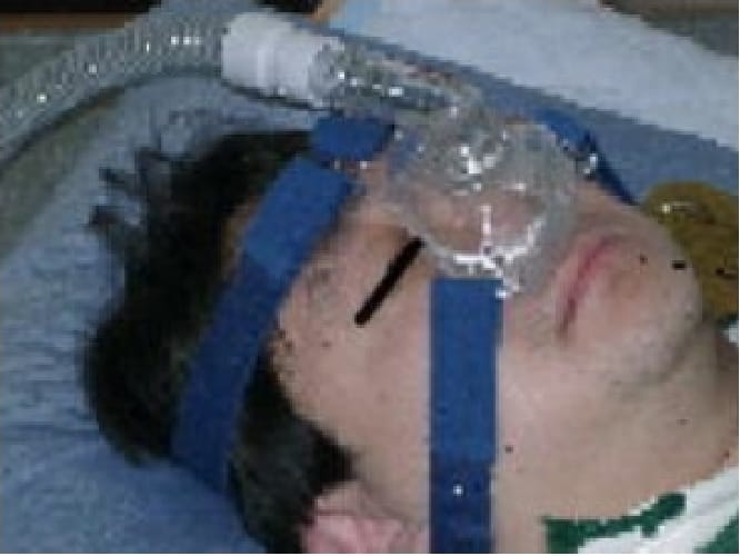 nasal-CPAP