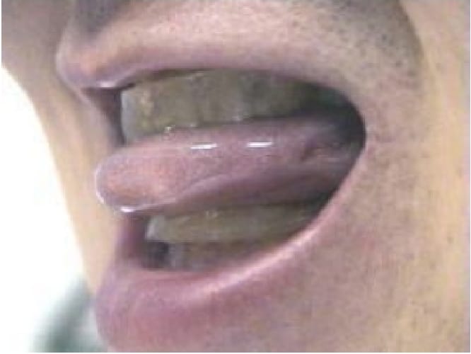 口腔内装置(マウスピース)